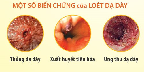 Cảnh giác với bệnh loét dạ dày như của nghệ sĩ Mạc Can - Hình 2 Canh giac voi benh loet da day nhu cua nghe si Mac Can-Hinh-2