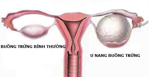 Cảnh giác với u nang buồng trứng ở trẻ nhỏ Canh giac voi u nang buong trung o tre nho