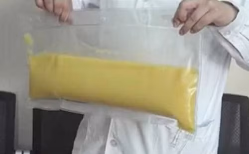 Ăn gà rán mỗi tối, bác sĩ tách được gần 2 lít dầu trong máu bệnh nhân - Hình 2 An ga ran moi toi, bac si tach duoc gan 2 lit dau trong mau benh nhan-Hinh-2