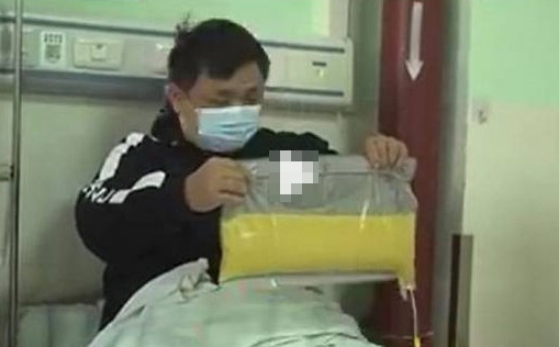 Ăn gà rán mỗi tối, bác sĩ tách được gần 2 lít dầu trong máu bệnh nhân An ga ran moi toi, bac si tach duoc gan 2 lit dau trong mau benh nhan