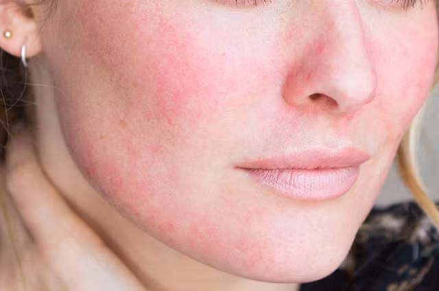 3 dac diem tren khuon mat cho thay dau hieu bi ung thu-Hinh-9