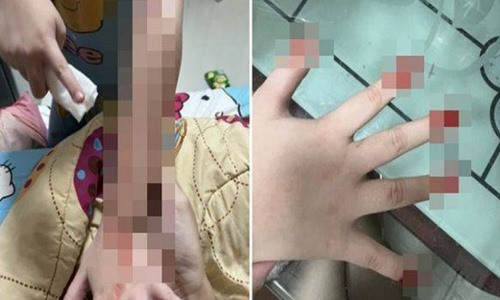 Biết gì về bệnh lạ, hễ căng thẳng là cơ thể tự chảy máu đầm đìa? Biet gi ve benh la, he cang thang la co the tu chay mau dam dia?