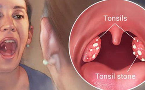 Dấu hiệu ung thư miệng cần cảnh giác - Hình 9 Dau hieu ung thu mieng can canh giac-Hinh-9