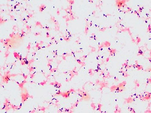 Cô gái bị viêm màng não nặng vì một món cực quen thuộc - Hình 8 Co gai bi viem mang nao nang vi mot mon cuc quen thuoc-Hinh-8