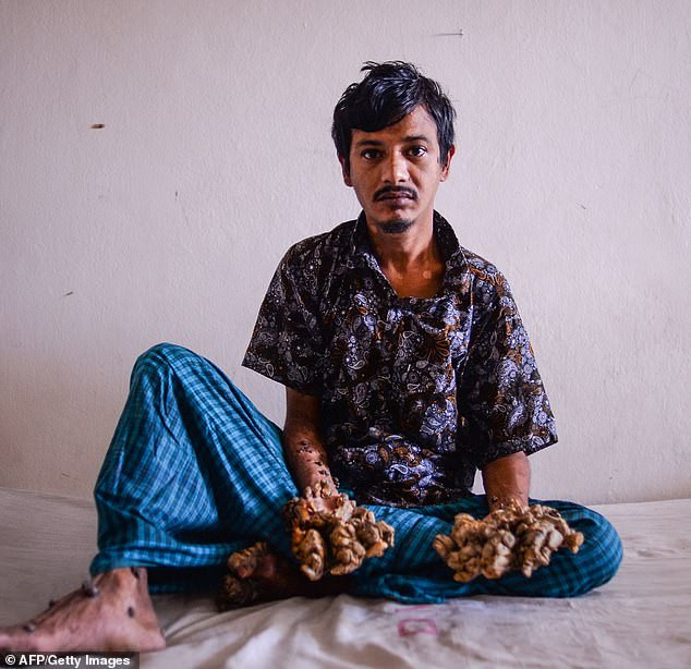 Ám ảnh đôi tay của người đàn ông mắc hội chứng 'người cây' Am anh doi tay cua nguoi dan ong mac hoi chung 'nguoi cay'