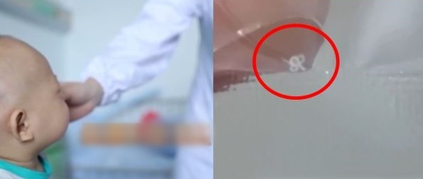 2 con giun sống trong mắt bệnh nhi 10 tháng tuổi 2 con giun song trong mat benh nhi 10 thang tuoi