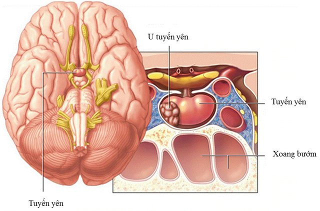 Ca sĩ Ánh Tuyết bị u tuyến yên: Cách phòng ngừa như nào? - Hình 2 Ca si Anh Tuyet bi u tuyen yen: Cach phong ngua nhu nao?-Hinh-2