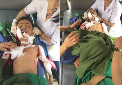 Cận cảnh những vụ trẻ em bị chó tấn công, thương tích cùng mình - Hình 2 Can canh nhung vu tre em bi cho tan cong, thuong tich cung minh-Hinh-2
