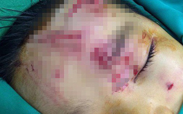 Cận cảnh những vụ trẻ em bị chó tấn công, thương tích cùng mình - Hình 5 Can canh nhung vu tre em bi cho tan cong, thuong tich cung minh-Hinh-5