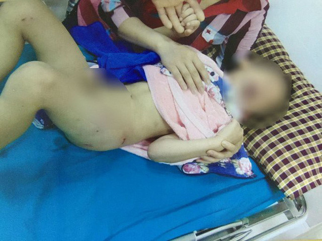 Cận cảnh những vụ trẻ em bị chó tấn công, thương tích cùng mình - Hình 9 Can canh nhung vu tre em bi cho tan cong, thuong tich cung minh-Hinh-9