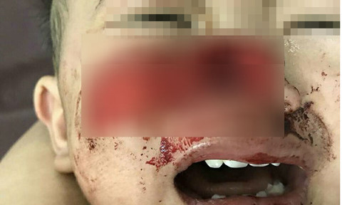 Cận cảnh những vụ trẻ em bị chó tấn công, thương tích cùng mình - Hình 12 Can canh nhung vu tre em bi cho tan cong, thuong tich cung minh-Hinh-12