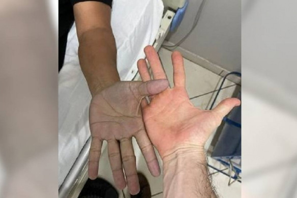 Tay đổi màu tưởng bệnh lạ hóa ra do thói quen này Tay doi mau tuong benh la hoa ra do thoi quen nay