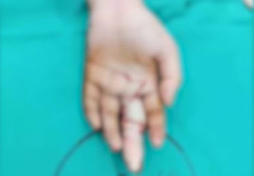 Nhẫn quá chật, cô gái vẫn cố kéo ra và rút luôn cả thịt ớn lạnh Nhan qua chat, co gai van co keo ra va rut luon ca thit on lanh