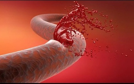 Hết sức thận trọng với những dấu hiệu cơ thể bị chảy máu trong Het suc than trong voi nhung dau hieu co the bi chay mau trong