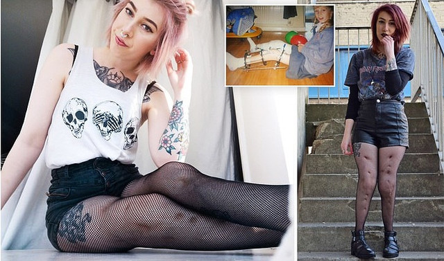 Tưởng ngồi xe lăn cả đời, cô gái đi lại bình thường nhờ đóng ghim vào chân Tuong ngoi xe lan ca doi, co gai di lai binh thuong nho dong ghim vao chan