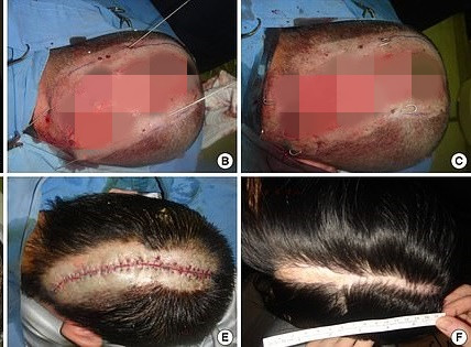 Dùng thuốc nhuộm tóc 'đểu', cô gái Hàn bị tróc hết cả da đầu Dung thuoc nhuom toc 'deu', co gai Han bi troc het ca da dau