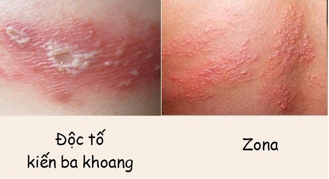 Bác sĩ chỉ cách xử lý và phòng tránh kiến ba khoang khi vào mùa - Hình 2 Bac si chi cach xu ly va phong tranh kien ba khoang khi vao mua-Hinh-2