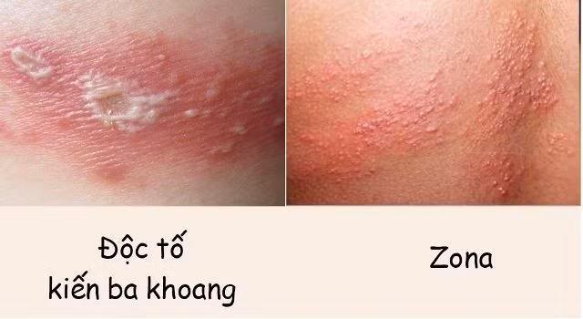 Bac si chi cach xu ly va phong tranh kien ba khoang khi vao mua-Hinh-2