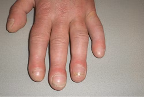 3 dau hieu xuat hien o ban tay co nguy co bi benh phoi-Hinh-2