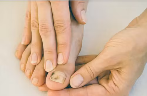 3 dau hieu o ngon chan canh bao te bao ung thu xuat hien-Hinh-2