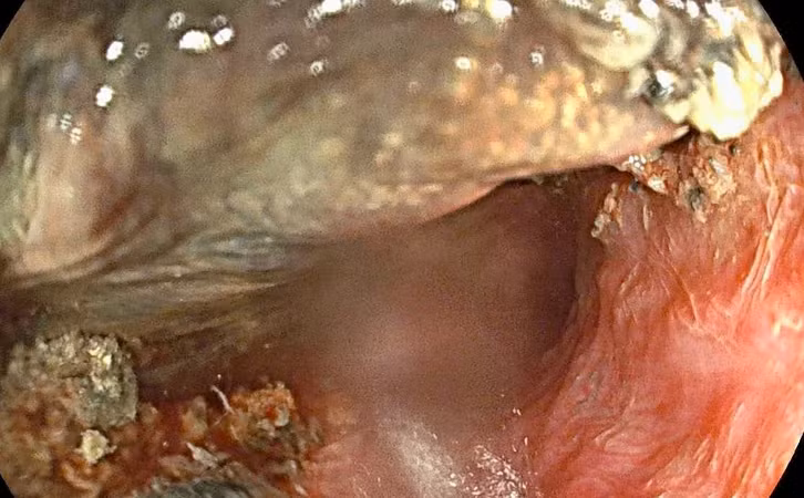 Bé 3 tuổi bị bỏng thực quản vì nuốt pin cúc áo: Cần cảnh giác cao độ