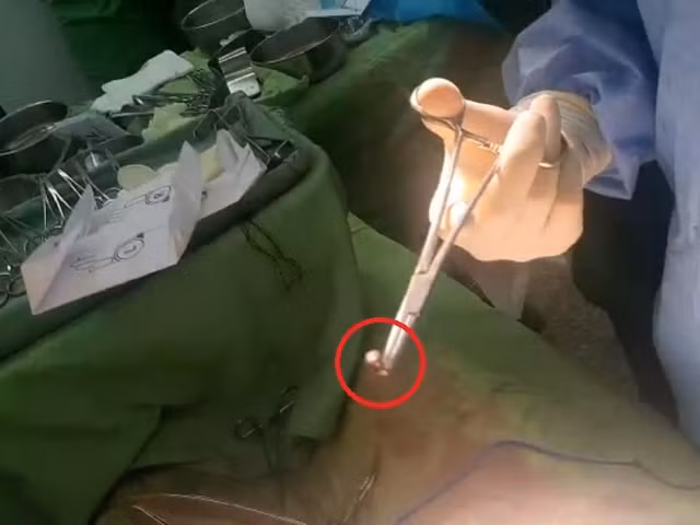 Cứu sống bệnh nhân bị đạn bắn thủng bụng ở miền Tây - Hình 2 Cuu song benh nhan bi dan ban thung bung o mien Tay-Hinh-2