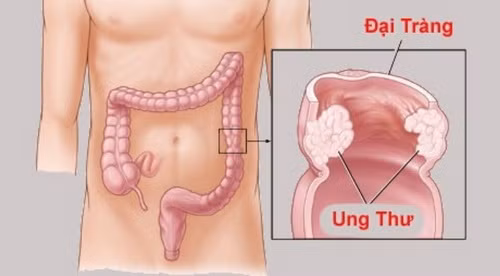 Chúng ta phải chăm sóc đại tràng bằng cách ăn nhiều chất xơ từ rau, trái cây, các loại hạt, ngũ cốc, và giảm tiêu thụ thịt đỏ, thực phẩm chiên, đường, rượu và cà phê. Nó cũng tốt để bỏ hút thuốc và bắt đầu uống đủ nước mỗi ngày. Hãy chú ý đến các triệu chứng ở trên và đừng ngần ngại gặp bác sĩ, nếu cần thiết. Ảnh: BS.