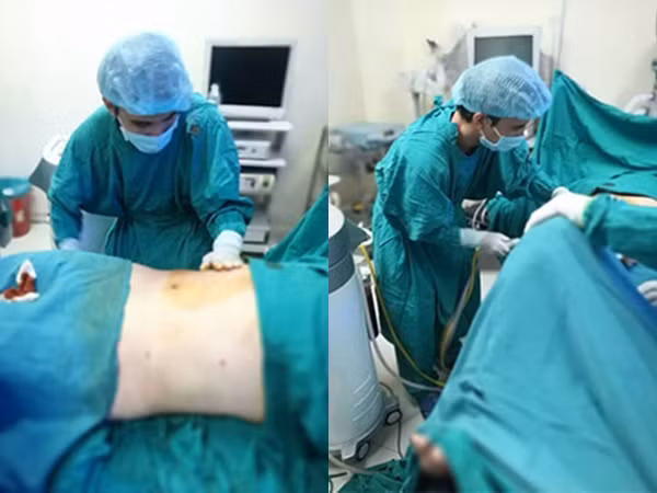Trước đó, bệnh nhân nữ Đỗ N.A vào Bệnh viện An Việt phẫu thuật tạo hình thành bụng vào ngày 6/4 vừa qua. Sau khi gây tê tủy sống, bệnh nhân có biểu hiện bất thường. Ngay sau khi xảy ra tình trạng bệnh nhân nghi sốc phản vệ, Bệnh viện An Việt đã cấp cứu và chuyển bệnh nhân sang Bệnh viện Bạch Mai cấp cứu. Nguyên nhân tử vong được xác định do bệnh nhân hôn mê sâu, tổn thương thiếu máu não diện nặng, phù não nặng sau ngừng tuần hoàn.