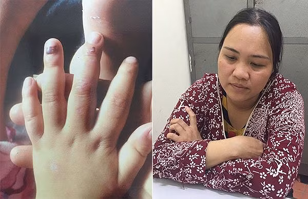 Bà Hải (bìa phải) đã hành hạ con gái người tình; trong đó đánh làm các ngón tay trẻ bầm dập (bìa trái). *ảnh: Nguyệt My Bà Hải (bìa phải) đã hành hạ con gái người tình; trong đó đánh làm các ngón tay trẻ bầm dập (bìa trái). *ảnh: Nguyệt My