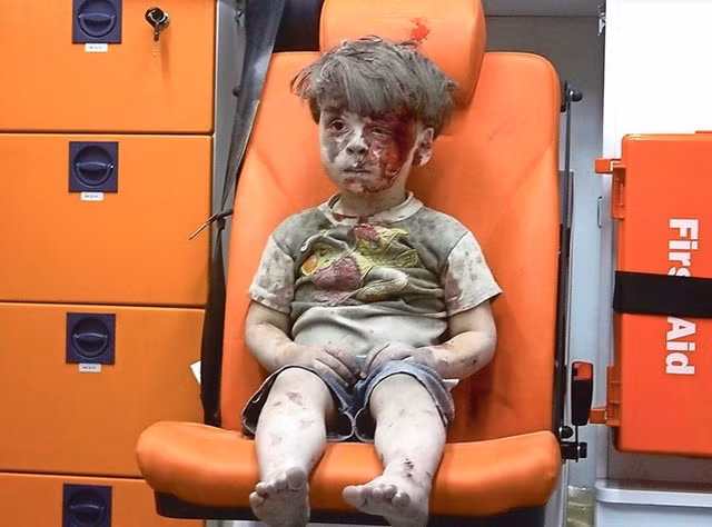 Bé Syria mặt rớm máu vẫn mỉm cười khiến dân mạng bật khóc - Hình 3 Be Syria mat rom mau van mim cuoi khien dan mang bat khoc-Hinh-3