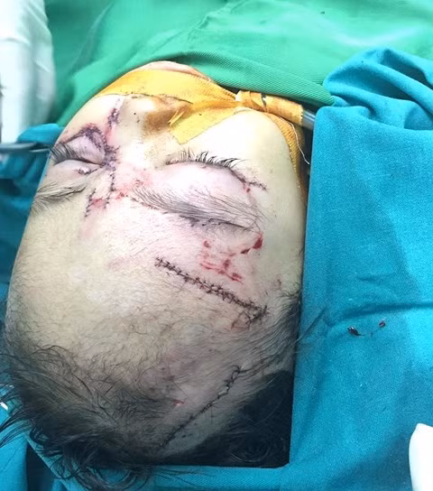 Bé gái 31 tháng tuổi bị chó nhà cắn nát mặt phải nhập viện cấp cứu Be gai 31 thang tuoi bi cho nha can nat mat phai nhap vien cap cuu