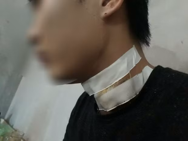 Anh T. phải khâu nhiều mũi sau pha cứa cổ của hai thanh niên. Nguồn ảnh: Zing Anh T. phải khâu nhiều mũi sau pha cứa cổ của hai thanh niên. Nguồn ảnh: Zing