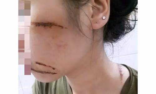 Hải Dương: Nữ nhân viên spa bị nhóm côn đồ chém trọng thương Hai Duong: Nu nhan vien spa bi nhom con do chem trong thuong