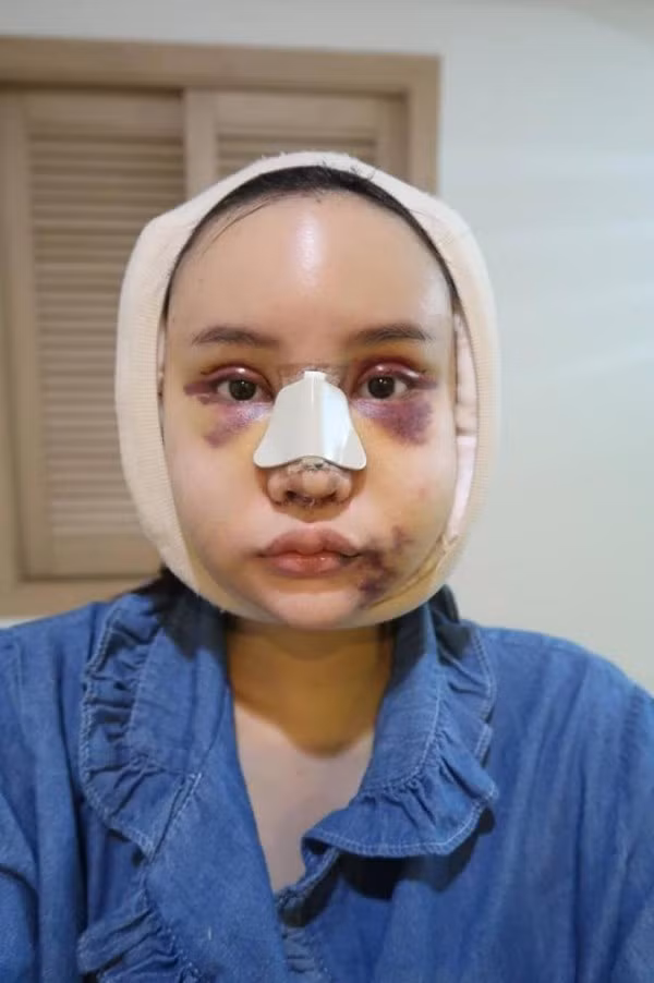 Sau ca phẫu thuật thẩm mỹ, gương mặt của Piyapeauty xưng phù nề và biến dạng. Cô không thể mở mắt hay ăn uống được.