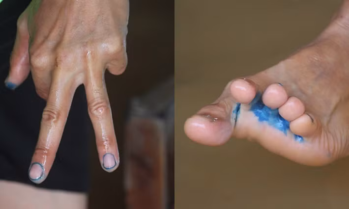 Chân, tay của người dân bị nước ăn do thường xuyên phải lội trong nước lũ.