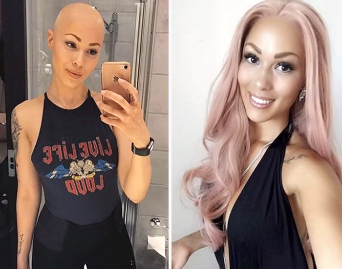 Hình ảnh trước và sau khi đội tóc giả của cựu y tá bệnh viện Malmo - Therese Hansson. Ảnh trong bài: Instagram nhân vật.