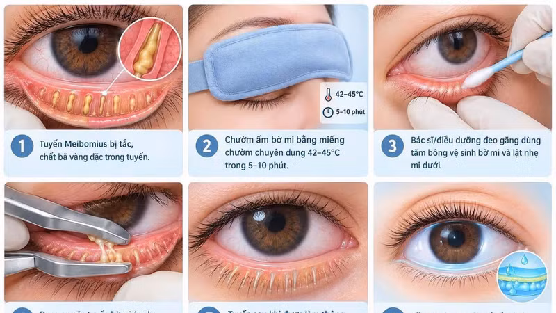Cách phòng ngừa, điều trị viêm bờ mi để bảo vệ sức khỏe mắt 