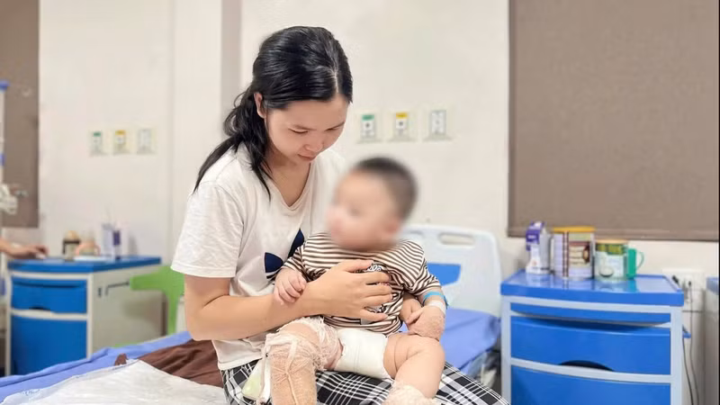 Cảnh báo bỏng do đồ nóng ở trẻ nhỏ: Nguy cơ trong sinh hoạt hàng ngày