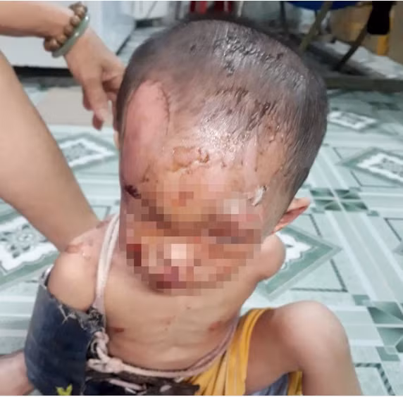 Nhìn thấy thương hình ảnh bé trai hơn 1 tuổi bị bạo hành dã man - Hình 2 Nhin thay thuong hinh anh be trai hon 1 tuoi bi bao hanh da man-Hinh-2