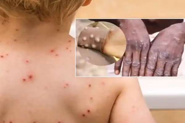 Vắc xin phòng đậu mùa khỉ được Châu Âu phê duyệt hoạt động như nào? Vac xin phong dau mua khi duoc Chau Au phe duyet hoat dong nhu nao?