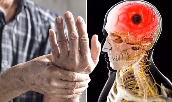 Dấu hiệu nhận biết sớm cơn đột quỵ nặng Dau hieu nhan biet som con dot quy nang