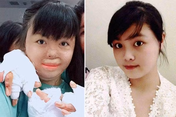 Chị Nguyễn Thùy Dung (SN 1994, xã Chàng Sơn, huyện Thạch Thất, Hà Nội) phải sống trong hình hài bị biến dạng khuôn mặt cùng một số bộ phận trên cơ thể. Dung chủ động viết đơn ly dị chồng là Nguyễn Văn Thành (SN 1991, xã Hòa Thạch, huyện Quốc Oai) do đối tượng này nghiệp ngập, cờ bạc. Níu kéo không được, Thành đã dùng xăng thiêu vợ. 