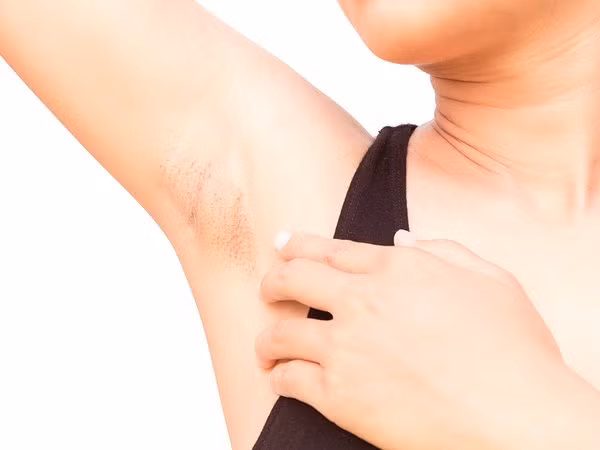  Cạo lông ở vùng nách Hãy giữ cho vùng da dưới cánh tay được sạch lông. Da ở vùng nách có nhiều lỗ chân lông tự nhiên giúp giữ độ ẩm cũng như ngăn ngừa tác dụng phụ của các chất chống tiết mồ hôi. Cạo hoặc tẩy lông ở vùng da dưới cánh tay bằng sáp hoặc kem tẩy lông sẽ giúp giữ cho da sạch và tiết ít mồ hôi. Đây là một trong những cách hiệu quả nhất để làm giảm tiết mồ hôi ở nách.