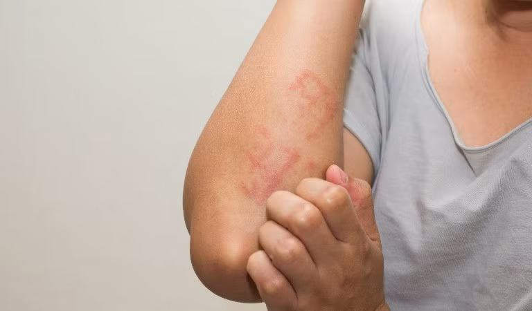 Mùa mưa tăng nguy cơ nhiễm ký sinh trùng, đừng chủ quan với ngứa kéo dài
