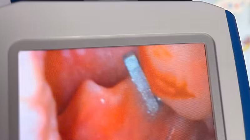 Hai trẻ nuốt nam châm trong một tháng, bác sĩ cảnh báo nguy hiểm
