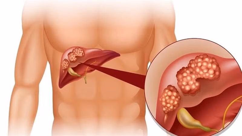 Dùng thuốc bắc không rõ nguồn gây tổn thương gan nặng cho bệnh nhân 61 tuổi