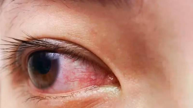 Đau mắt đỏ dễ lây lan mùa mưa, lưu ý phòng tránh để bảo vệ mắt