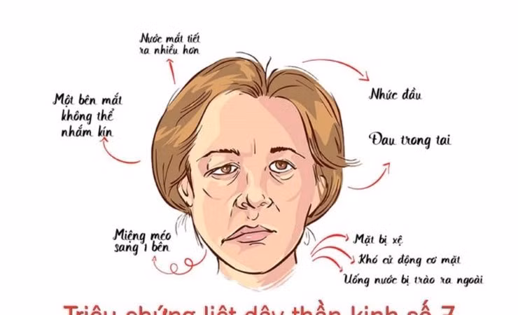 Liệt dây thần kinh số 7: Nhận biết sớm để tránh biến chứng nặng