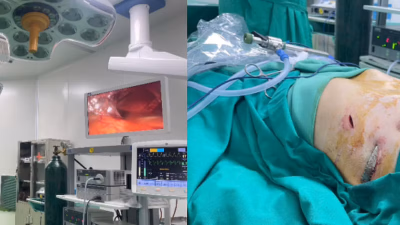 Phẫu thuật Nuss giúp trẻ bị lõm ngực bẩm sinh cải thiện cuộc sống
