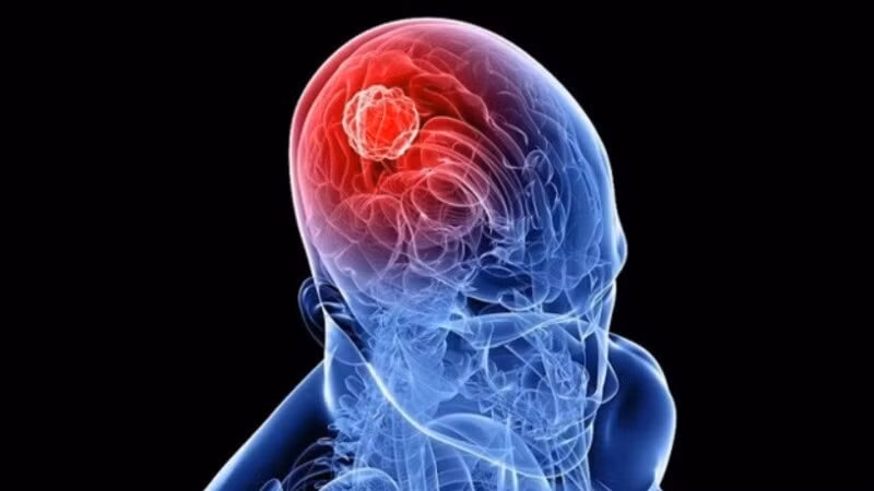 Dấu hiệu cảnh báo u não cần chú ý để tránh biến chứng nguy hiểm